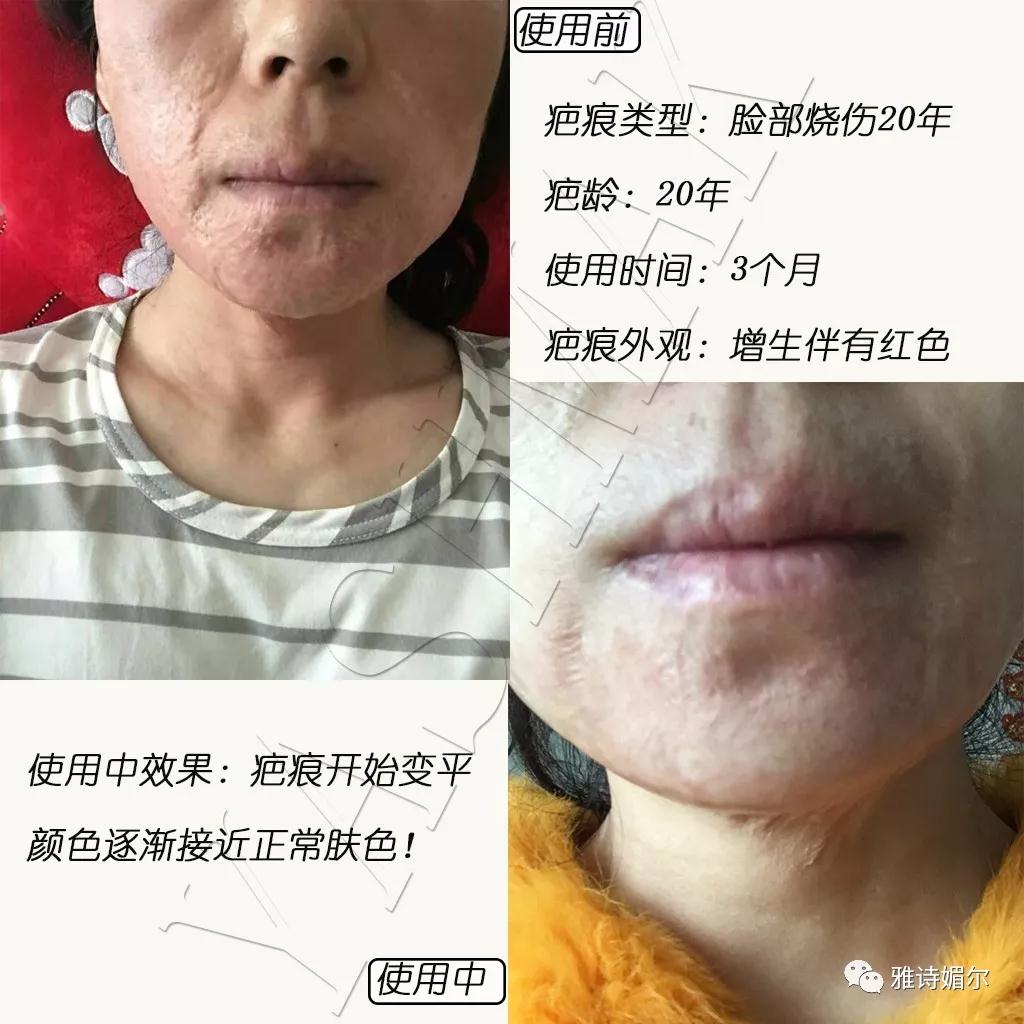 疤痕的种类有多少?雅诗媚尔隐形蜂膜凝胶可以修复多少